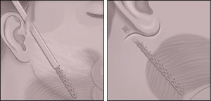 lifting gat implant